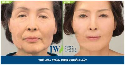 Cơ hội cấy mỡ trẻ hóa khuôn mặt giá sốc với chuyên gia Hàn Quốc